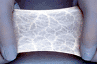 Image: The CorMatrix ECM cellular bioscaffold (Photo courtesy of CorMatrix). Image: The CorMatrix ECM cellular bioscaffold (Photo courtesy of CorMatrix).